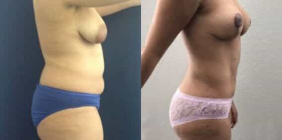 mommy makeover colombia 244-3-min