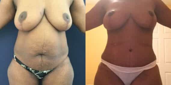 mommy makeover colombia 245-1-min