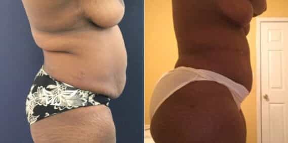 mommy makeover colombia 245-2-min