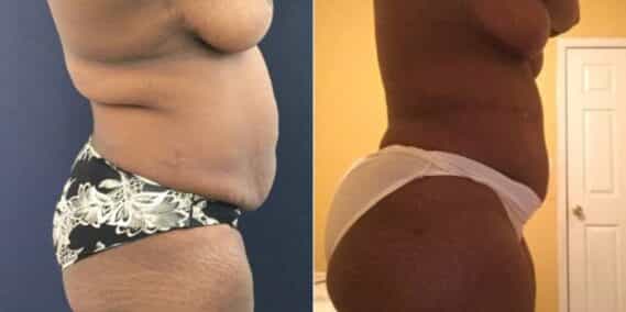 mommy makeover colombia 245-3-min