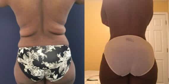 mommy makeover colombia 245-4-min