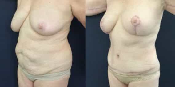 mommy makeover colombia 246-2-min