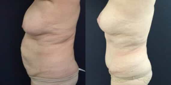 mommy makeover colombia 246-3-min