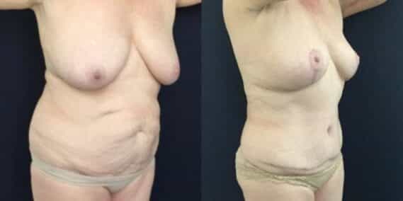 mommy makeover colombia 246-4-min