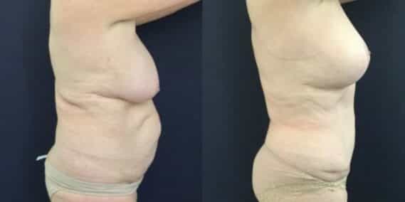 mommy makeover colombia 246-5-min