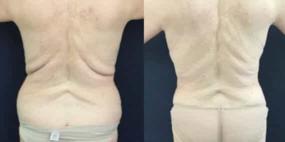 mommy makeover colombia 246-6-min