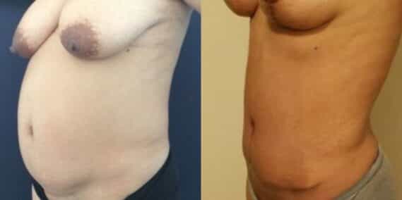 mommy makeover colombia 247-2-min