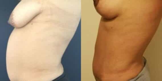 mommy makeover colombia 247-3-min