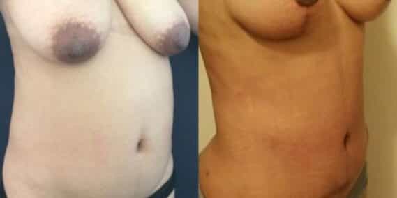 mommy makeover colombia 247-4-min