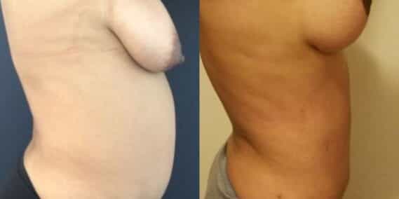 mommy makeover colombia 247-5-min