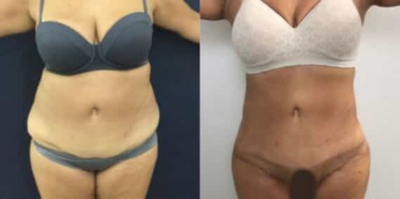 mommy makeover colombia 248-1-min