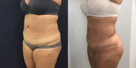 mommy makeover colombia 248-2-min