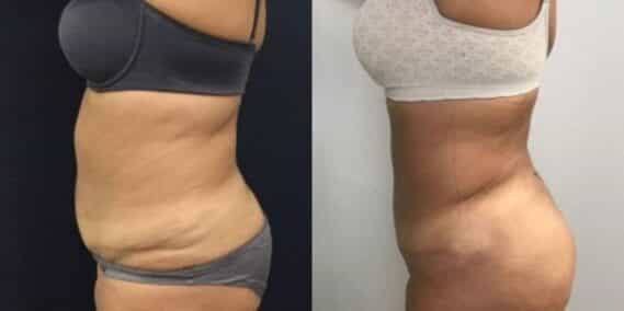 mommy makeover colombia 248-3-min