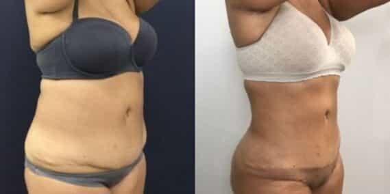 mommy makeover colombia 248-4-min