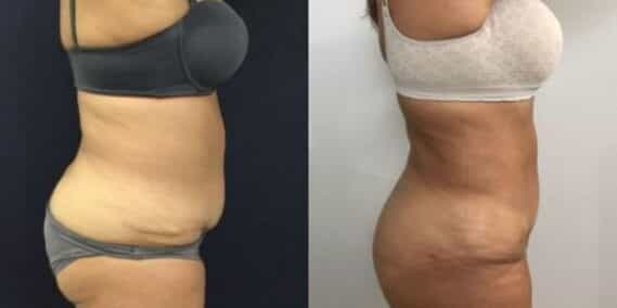 mommy makeover colombia 248-5-min