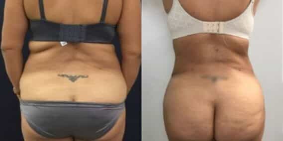 mommy makeover colombia 248-6-min