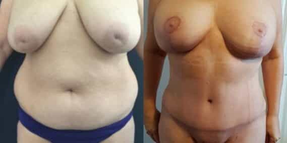 mommy makeover colombia 252-1-min