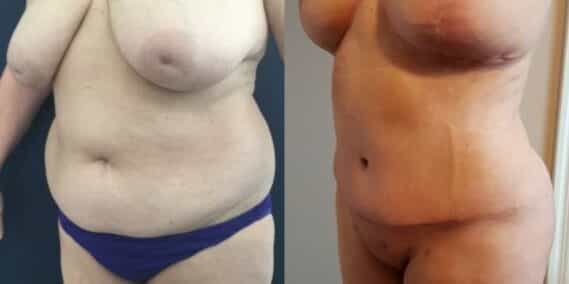 mommy makeover colombia 252-2-min
