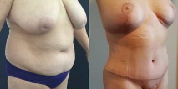 mommy makeover colombia 252-3-min