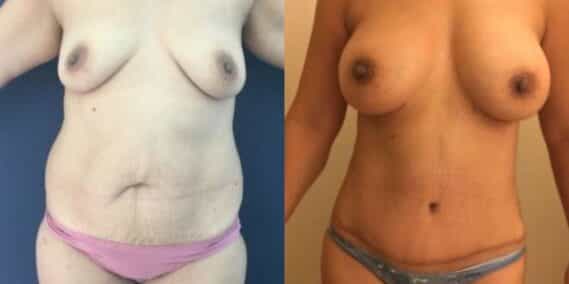 mommy makeover colombia 254-1-min