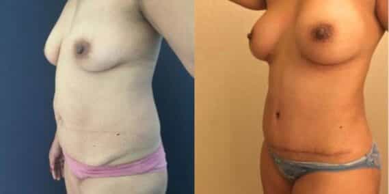 mommy makeover colombia 254-2-min