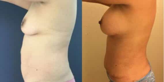 mommy makeover colombia 254-3-min