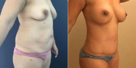 mommy makeover colombia 254-4-min
