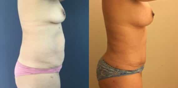 mommy makeover colombia 254-5-min