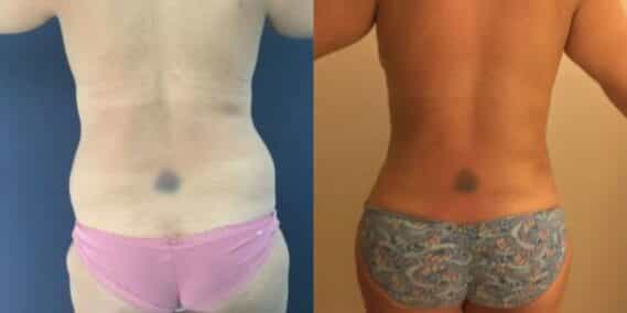 mommy makeover colombia 254-6-min
