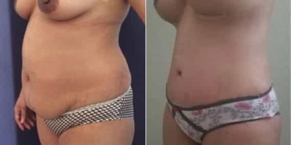mommy makeover colombia 257-2-min