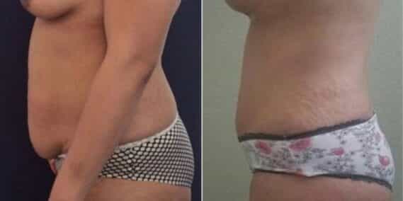 mommy makeover colombia 257-3-min