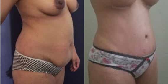 mommy makeover colombia 257-4-min