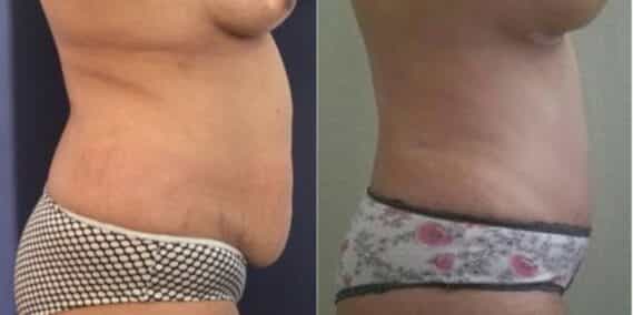 mommy makeover colombia 257-5-min