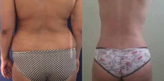 mommy makeover colombia 257-6-min
