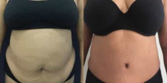 mommy makeover colombia 259-1-min