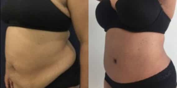 mommy makeover colombia 259-2-min