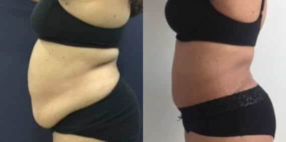 mommy makeover colombia 259-3-min