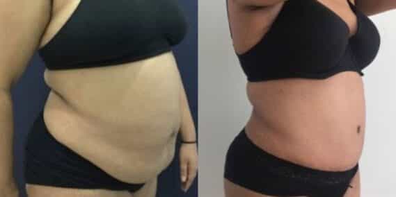 mommy makeover colombia 259-4-min
