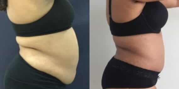 mommy makeover colombia 259-5-min