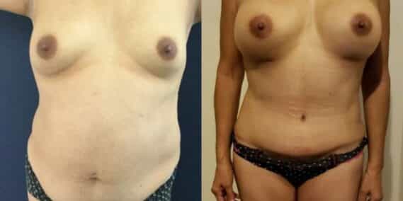 mommy makeover colombia 261-1-min