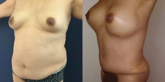 mommy makeover colombia 261-2-min