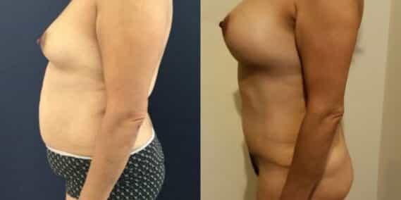 mommy makeover colombia 261-3-min