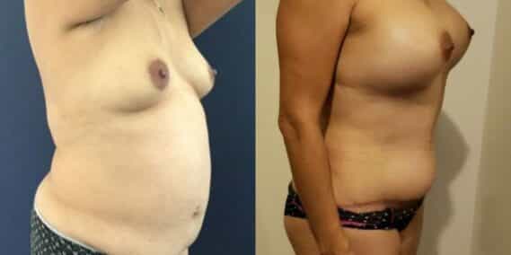 mommy makeover colombia 261-4-min