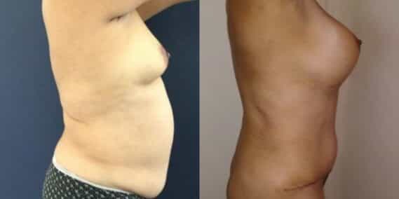 mommy makeover colombia 261-5-min