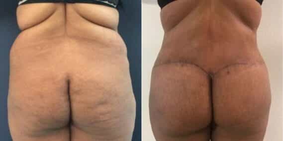 mommy makeover colombia 263-3-min