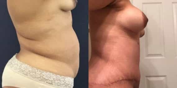 mommy makeover colombia 265-5-min