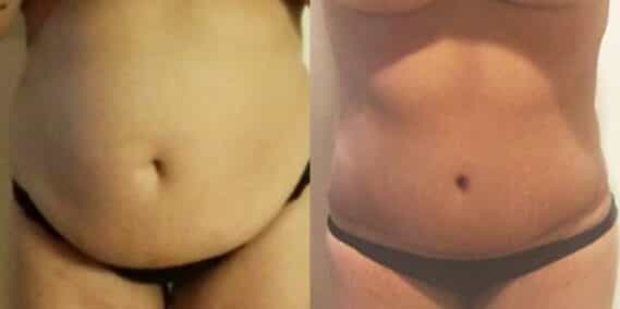 mommy makeover colombia 266-1-min