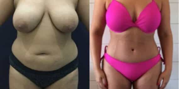 mommy makeover colombia 271-1-min