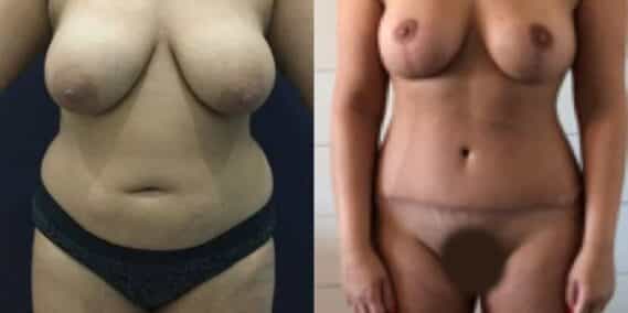 mommy makeover colombia 271-2-min