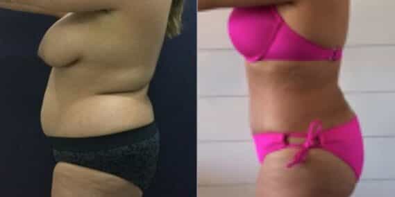mommy makeover colombia 271-3-min
